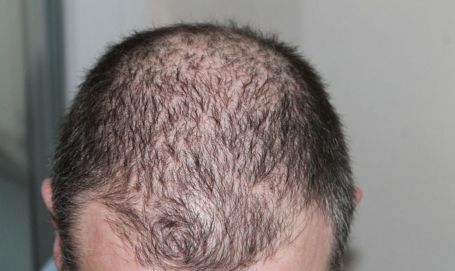 Comment réduire les chutes de cheveux et favoriser la repousse capillaire ?
